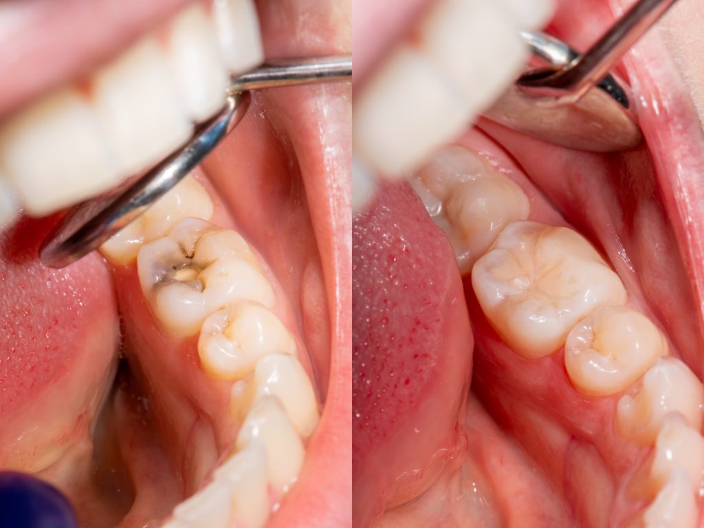 Teeth filling in a North York dentistry