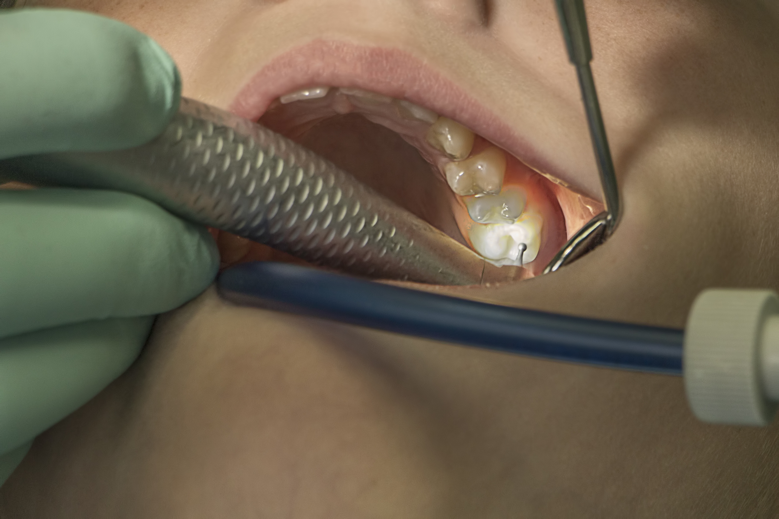 Bone grefting in a North York dentistry