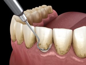 Teeth filling in a North York dentistry