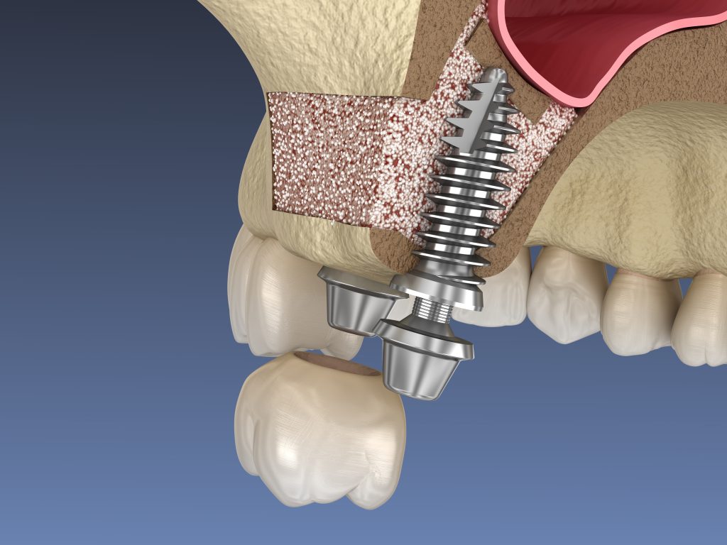 Tooth implant surgery in a North York dentistry