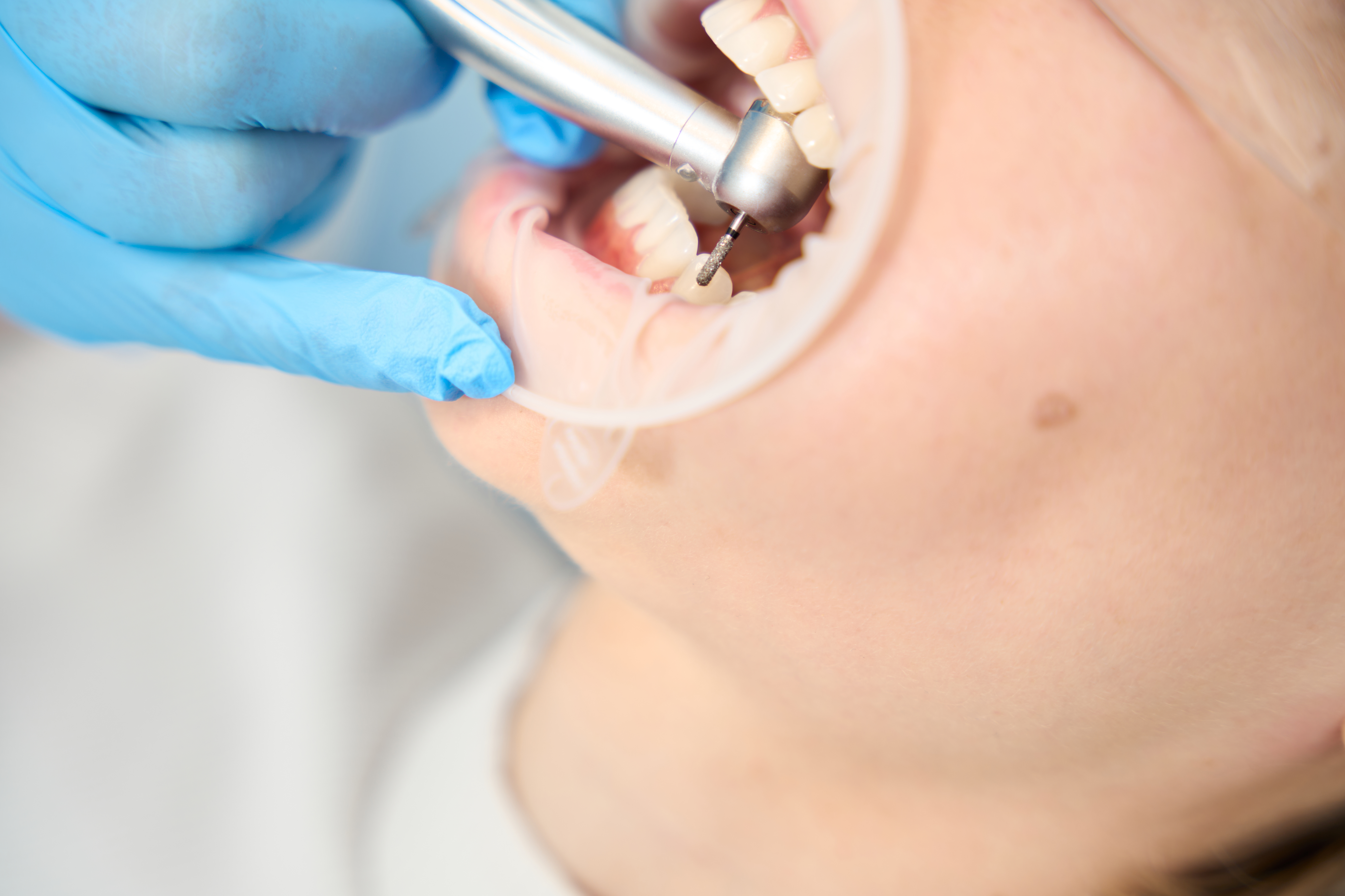 Bone grefting in a North York dentistry