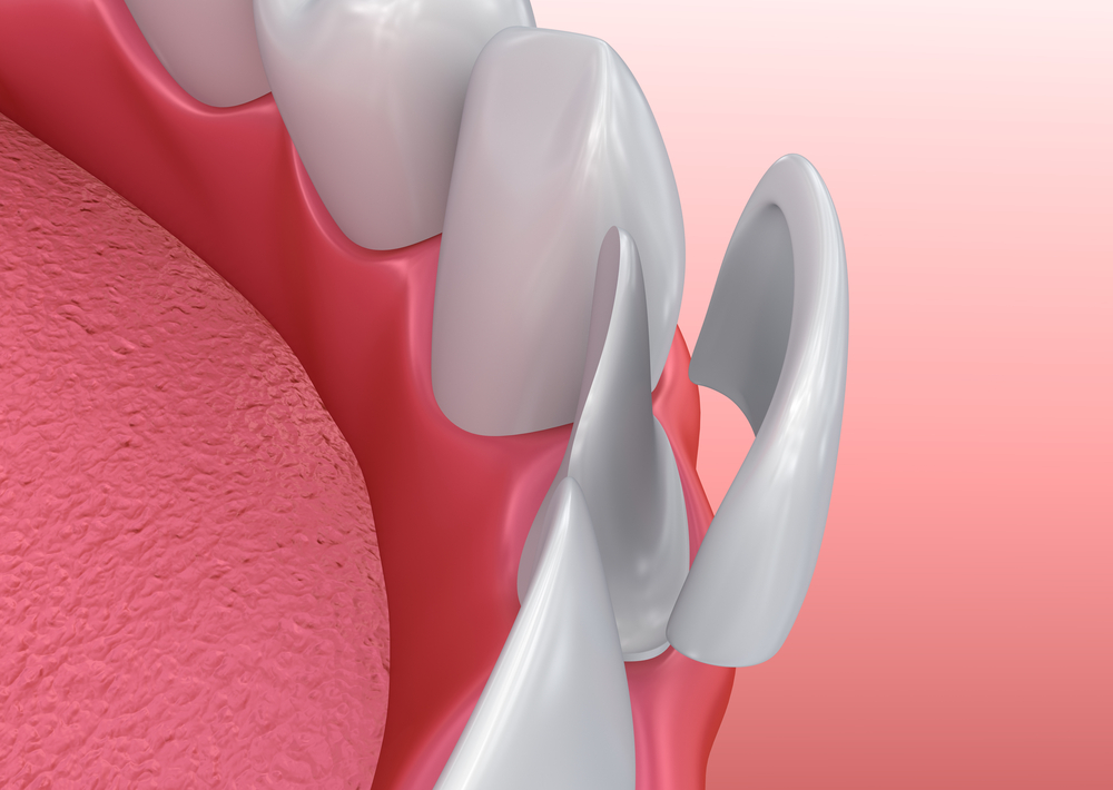 Dental crowns in a North York dentistry