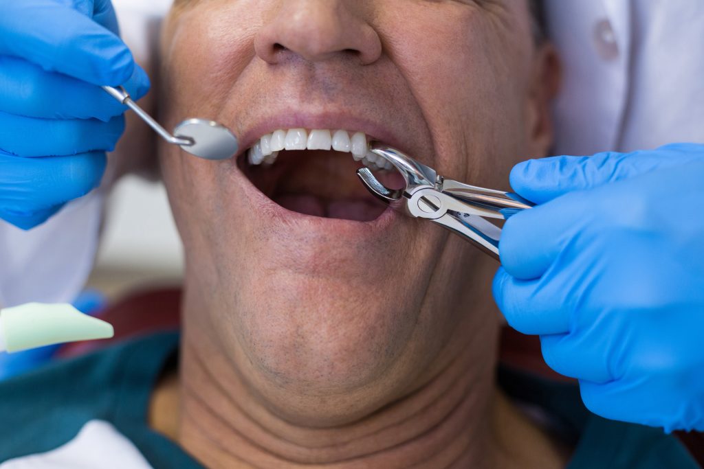 Teeth bonding in North York